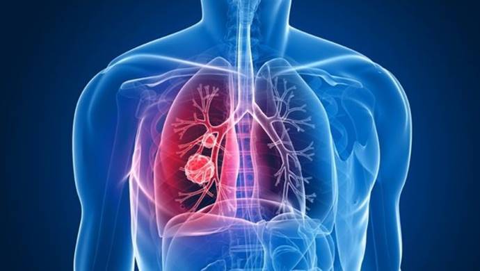 En çok görülen Akciğer Hastalığı: KOAH